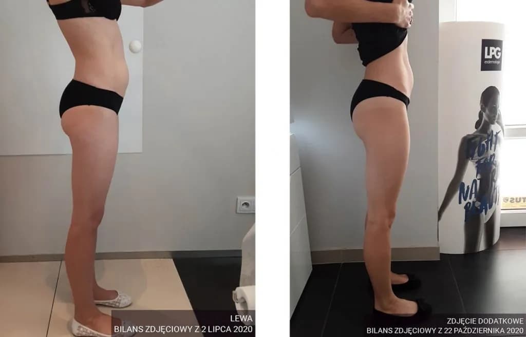 Ile zabiegów endermologii potrzeba, aby uzyskać widoczne efekty?