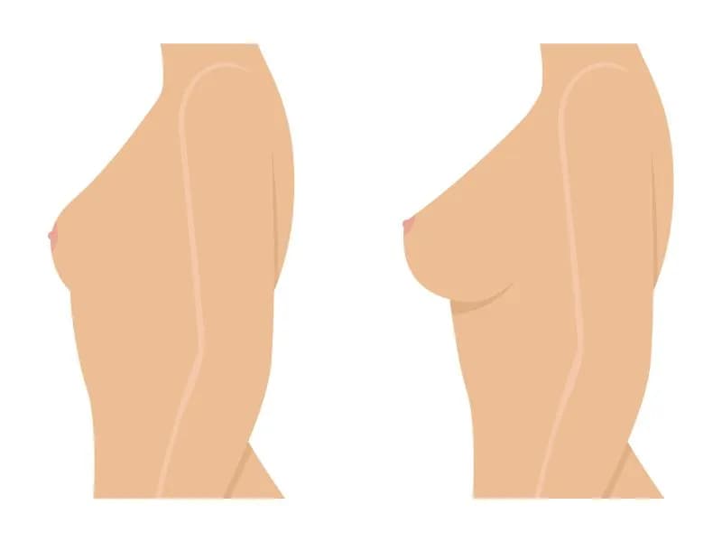 Lipofilling biustu jak długo się utrzymuje: Prawda o trwałości efektów