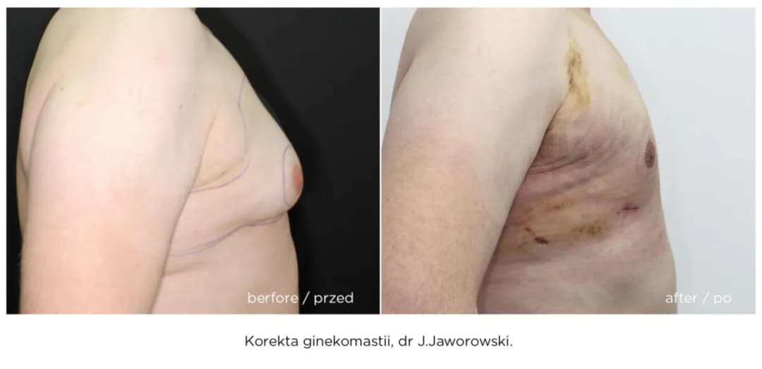 Wygląd piersi po rekonstrukcji: Zobacz efekty i zdjęcia przed i po zabiegu