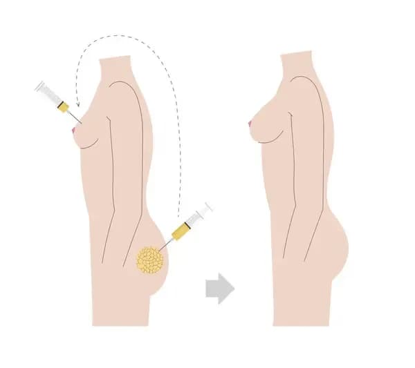 Lipofilling biustu - wszystko co musisz wiedzieć przed zabiegiem w 2025