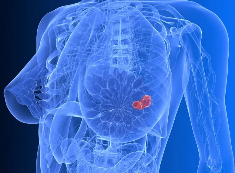 Jak szybko rośnie guz w piersiach? Co wpływa na tempo rozwoju nowotworu