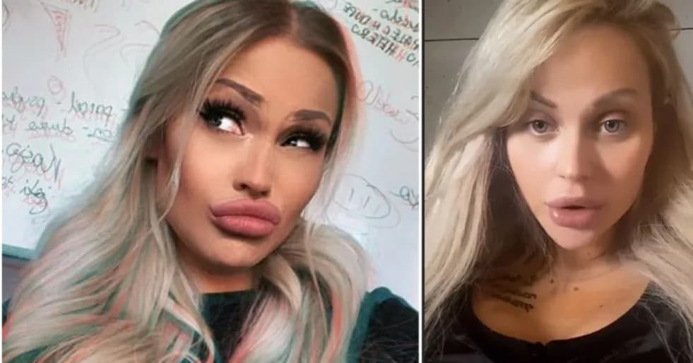 Kiedy zniknie opuchlizna po operacji biustu - sprawdzony proces gojenia