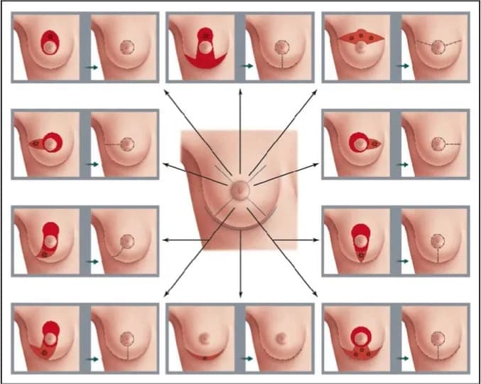 Jak długo boli pierś po operacji oszczędzającej? Poznaj realia i fakty